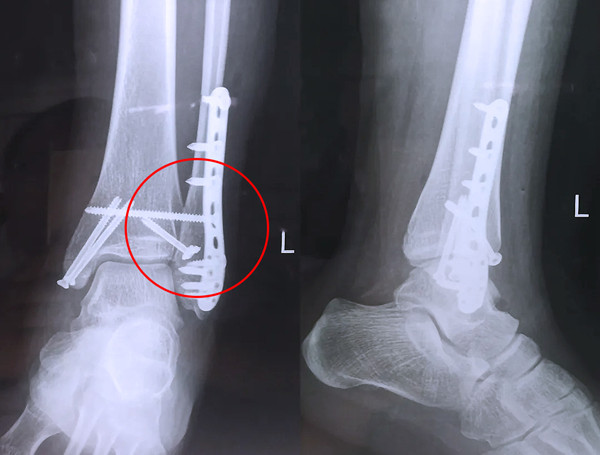 【醫療科普】之外踝骨折 【醫療科普】之外踝骨折